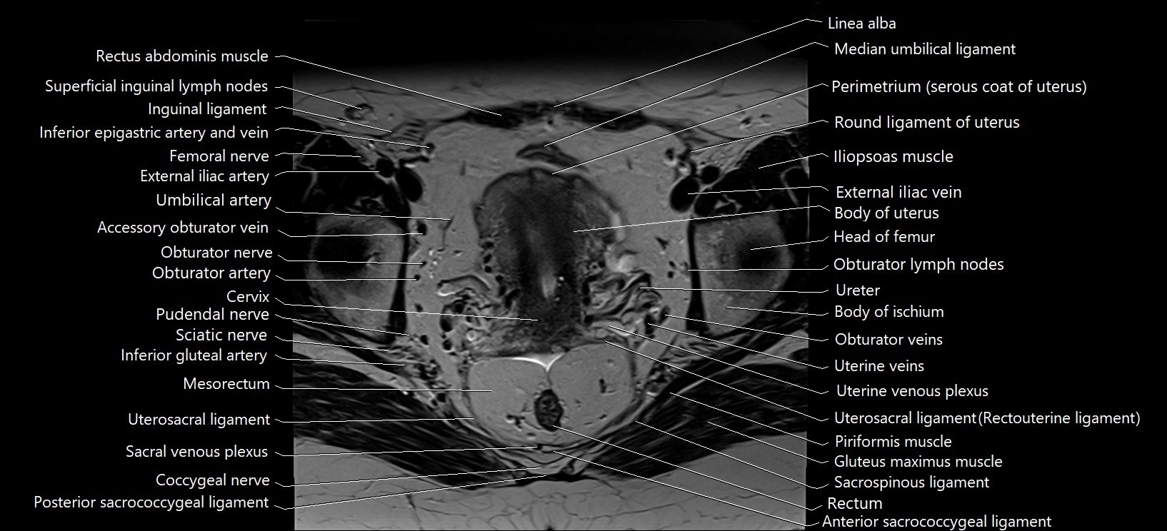 Axial cross sectional anatomy of female pelvis (MRI 3T) image 21.webp